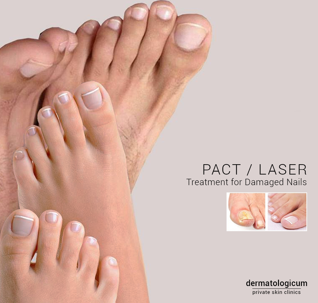 Pact and Laser Nail Fungus Therapy Dermatologicum